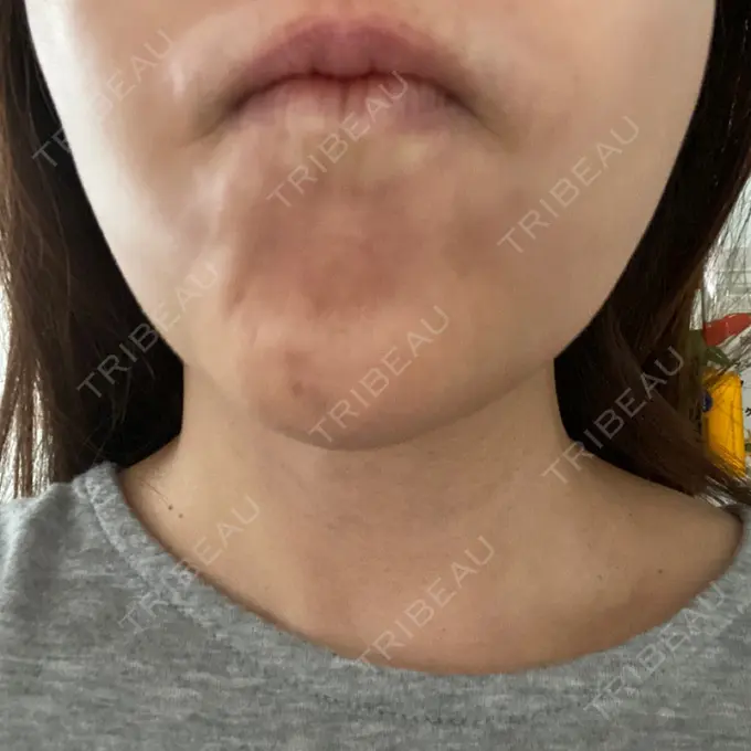 シワ取りボトックス 湘南美容クリニック 自由が丘院 DAY 4 メイン用