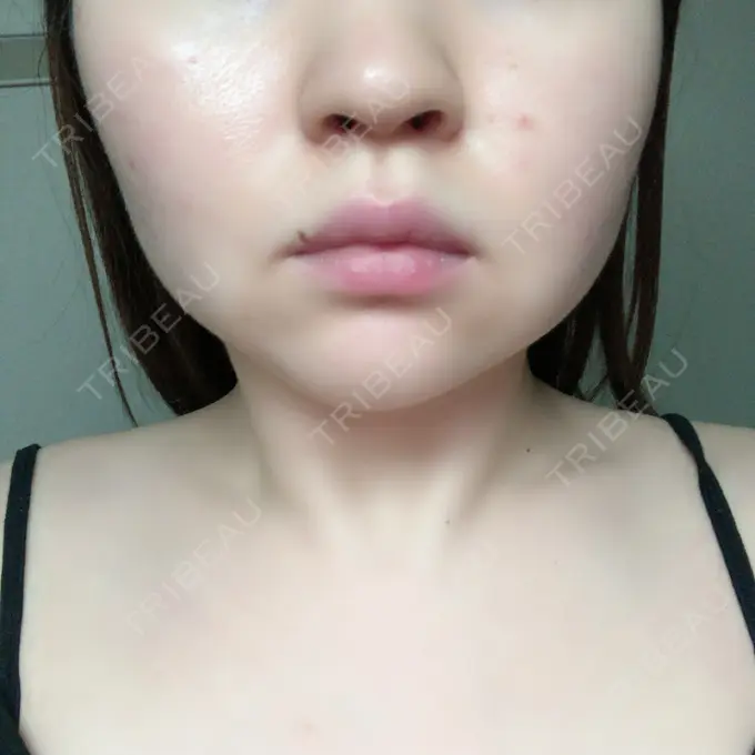 脂肪溶解注射（顔） 赤坂プレミアクリニック DAY 8 メイン用