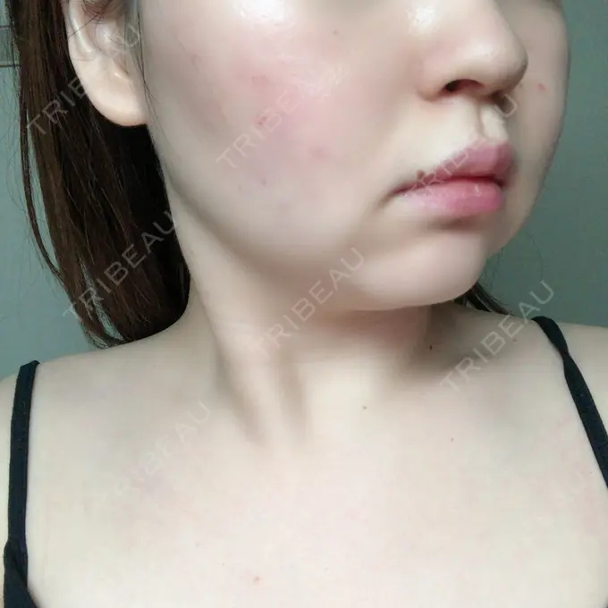 脂肪溶解注射（顔） 赤坂プレミアクリニック DAY 8 メイン用