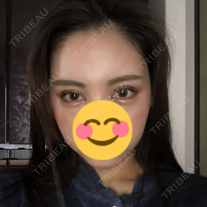 二重切開 / 目頭切開 / クマ治療 / バッカルファット除去 / 脂肪吸引（顔） / 額を丸く / 目尻切開 ヴェリテクリニック 名古屋院 DAY 28 メイン用