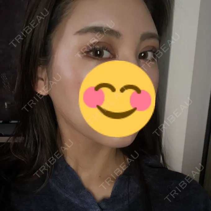 二重切開 / 目頭切開 / クマ治療 / バッカルファット除去 / 脂肪吸引（顔） / 額を丸く / 目尻切開 ヴェリテクリニック 名古屋院 DAY 28 メイン用