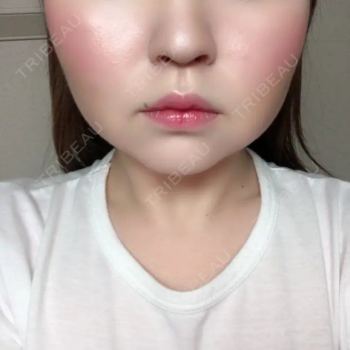 脂肪溶解注射（顔） 赤坂プレミアクリニック DAY 9 メイン用