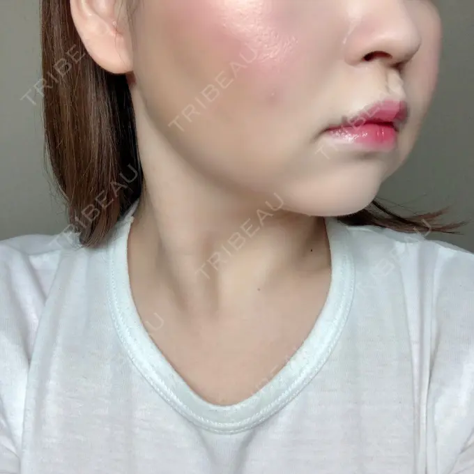 脂肪溶解注射（顔） 赤坂プレミアクリニック DAY 9 メイン用