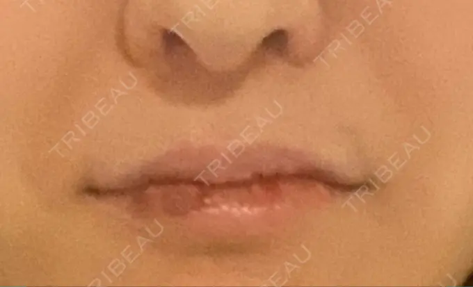 ヒアルロン酸注入（唇） / ボトックス（口角） もとび美容外科クリニック 新宿院 DAY 3 メイン用