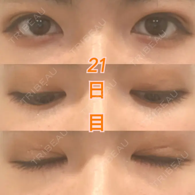 二重埋没 湘南美容クリニック 東京蒲田院 DAY 21 メイン用