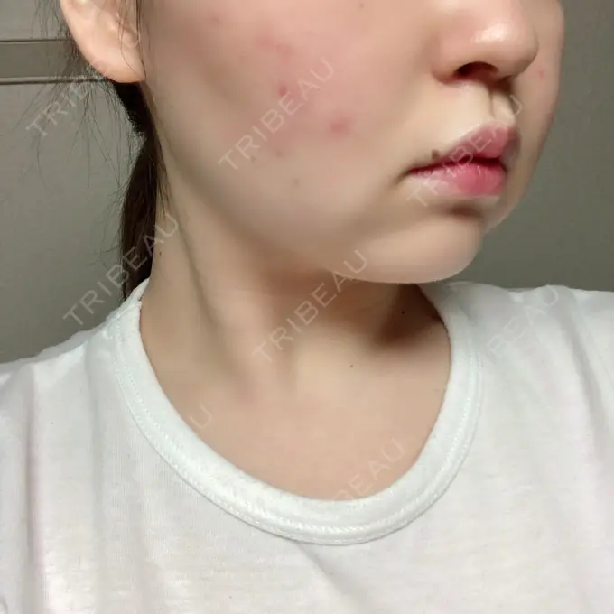 脂肪溶解注射（顔） 赤坂プレミアクリニック DAY 10 メイン用