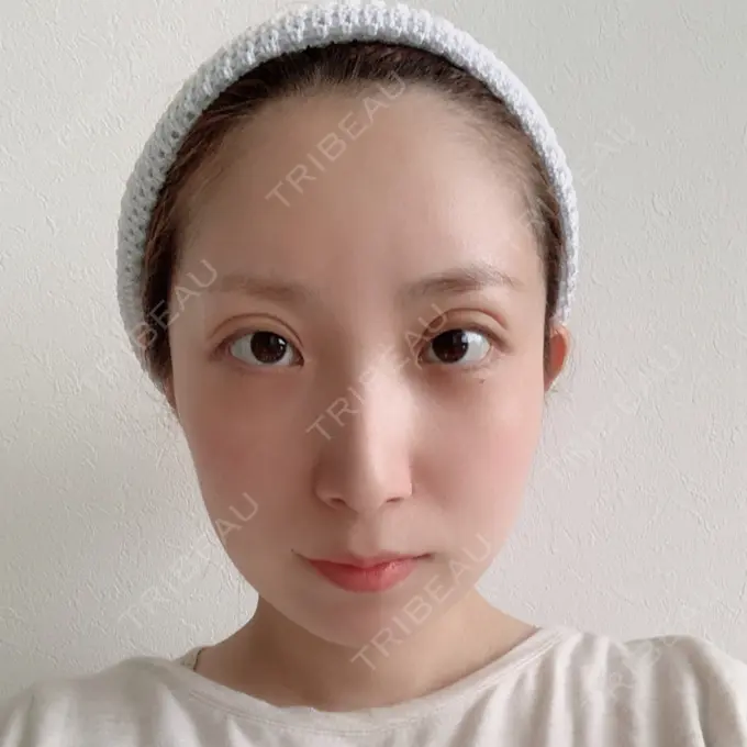 二重埋没 / 額を丸く / 下まぶたたるみ取り / 下まぶたの脂肪取り / 脂肪注入（肌） / 脂肪注入（額） / ボトックス（あご） 湘南美容クリニック 秋葉原院 DAY 54 メイン用