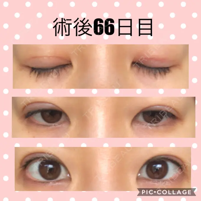 二重切開 マリアクリニック 安城院 DAY 66 メイン用