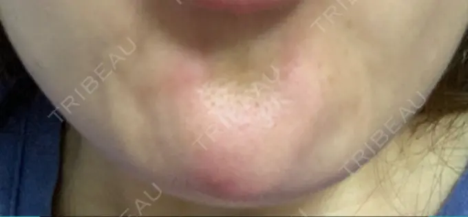 ボトックス（あご） TCB東京中央美容外科 心斎橋筋院 DAY 4 メイン用