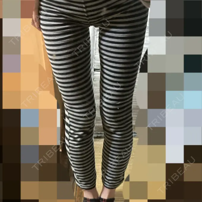 脂肪吸引（脚） / 脂肪吸引（お尻） ドクターフィット（Dr.fit）クリニック AFTER メイン用