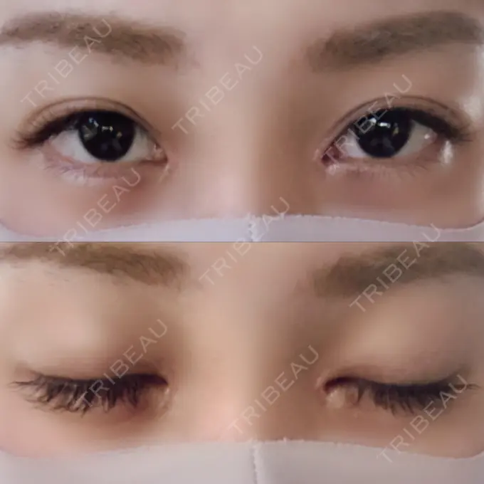 二重埋没 / 目頭切開 ドクター松井クリニック 新宿 DAY 47 メイン用