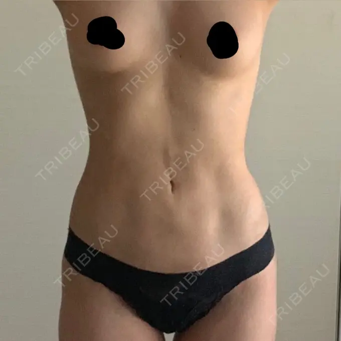 脂肪吸引（お腹） WOM CLINIC GINZA （ワム クリニック ギンザ） DAY 25 メイン用