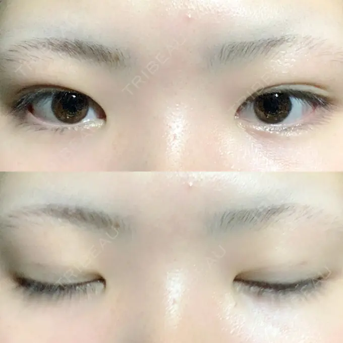 二重埋没 / 上まぶたの脂肪取り TCB東京中央美容外科 新横浜院 DAY 38 メイン用