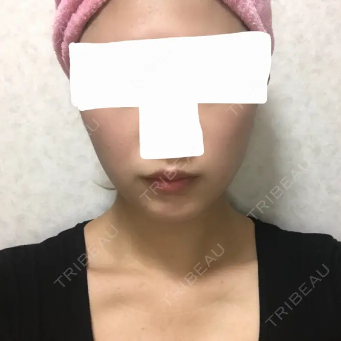 バッカルファット除去 / 脂肪吸引（顔） ジョウクリニック 大阪院 DAY 70 メイン用