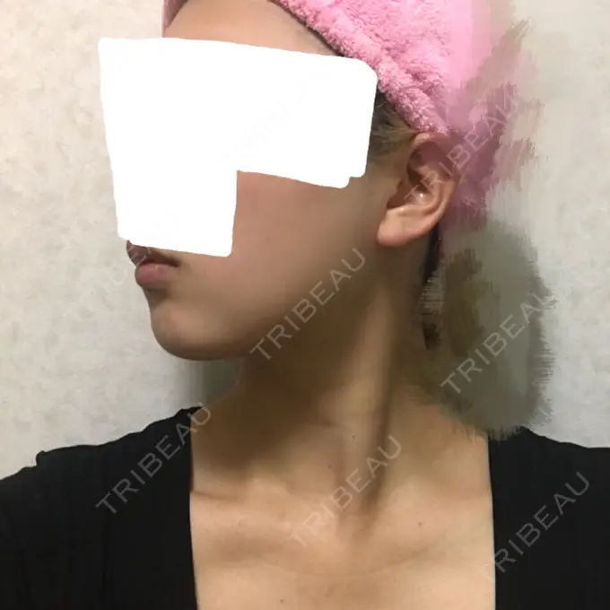 バッカルファット除去 / 脂肪吸引（顔） ジョウクリニック 大阪院 DAY 70 メイン用