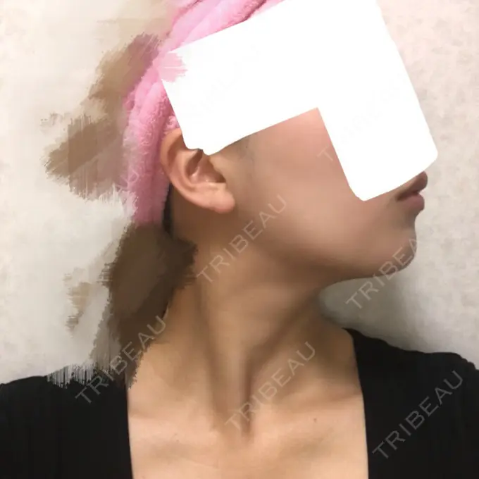 バッカルファット除去 / 脂肪吸引（顔） ジョウクリニック 大阪院 DAY 70 メイン用