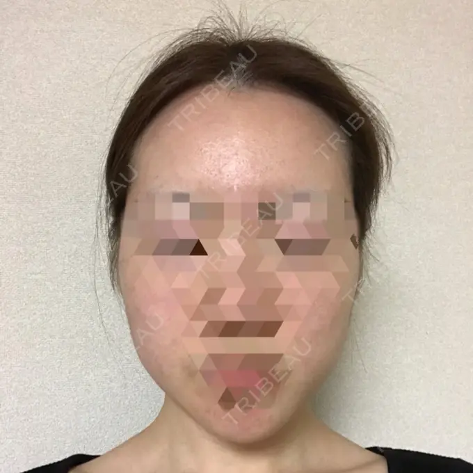 糸リフト / 骨切り（あご） / 骨削り（エラ） RG整形外科（旧リオン整形外科） DAY 92 メイン用