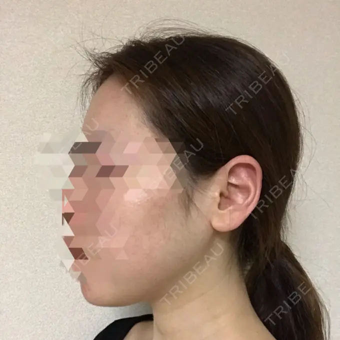 糸リフト / 骨切り（あご） / 骨削り（エラ） RG整形外科（旧リオン整形外科） DAY 92 メイン用