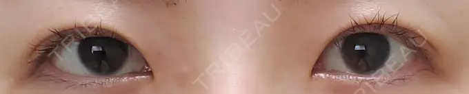 二重切開 ティーズクリニック DAY 93 メイン用