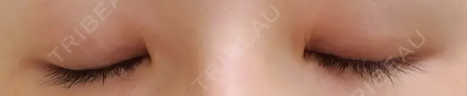 二重切開 ティーズクリニック DAY 93 メイン用