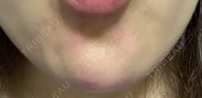 ボトックス（あご） TCB東京中央美容外科 心斎橋筋院 DAY 5 メイン用