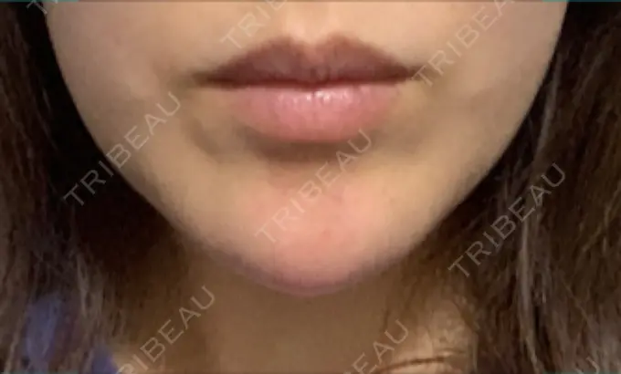 ボトックス（あご） TCB東京中央美容外科 心斎橋筋院 DAY 5 メイン用