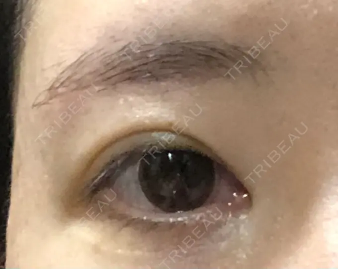 眉下切開 湘南美容クリニック 秋葉原院 DAY 68 メイン用