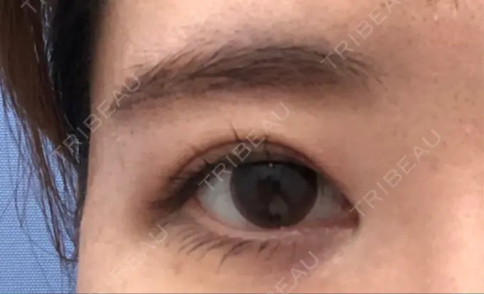 眉下切開 湘南美容クリニック 秋葉原院 DAY 68 メイン用