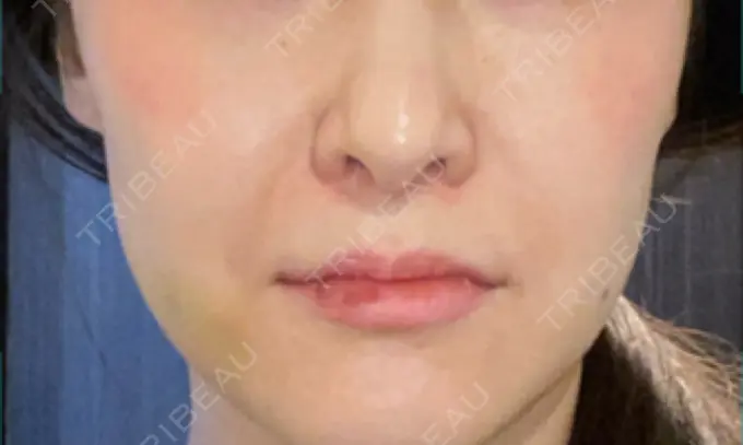 ヒアルロン酸注入（唇） / ボトックス（口角） もとび美容外科クリニック 新宿院 DAY 5 メイン用