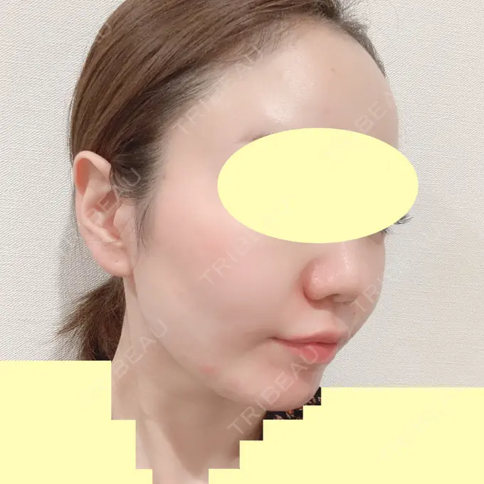 糸リフト / 肌ヒアルロン酸注入（たるみ・シワ改善） TCB東京中央美容外科 中野院 DAY 52 メイン用