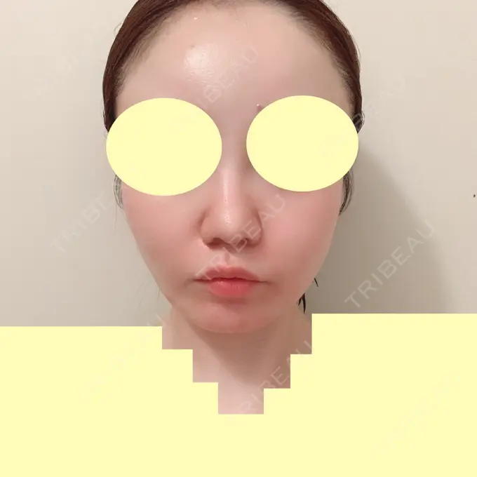 糸リフト / 肌ヒアルロン酸注入（たるみ・シワ改善） TCB東京中央美容外科 中野院 DAY 52 メイン用