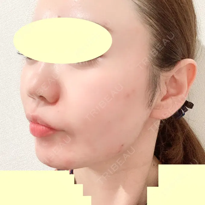 糸リフト / 肌ヒアルロン酸注入（たるみ・シワ改善） TCB東京中央美容外科 中野院 AFTER メイン用