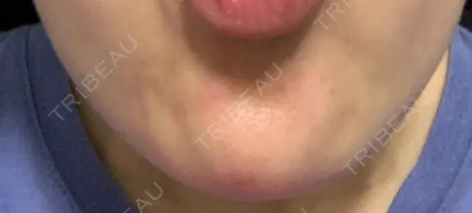 ボトックス（あご） TCB東京中央美容外科 心斎橋筋院 DAY 6 メイン用