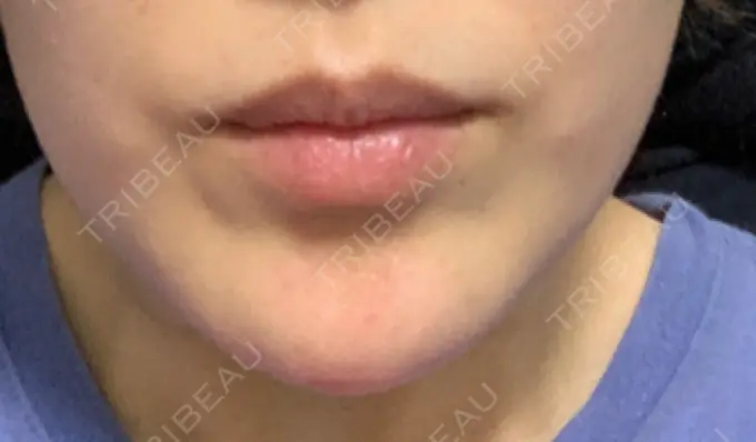 ボトックス（あご） TCB東京中央美容外科 心斎橋筋院 DAY 6 メイン用