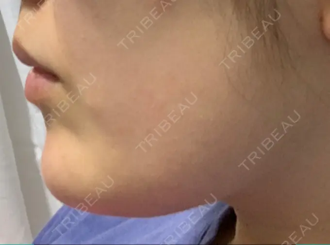 ボトックス（あご） TCB東京中央美容外科 心斎橋筋院 DAY 6 メイン用