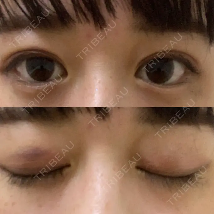 二重埋没 湘南美容クリニック 金沢院 DAY 9 メイン用