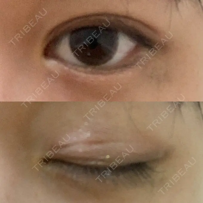 二重埋没 湘南美容クリニック 金沢院 DAY 9 メイン用