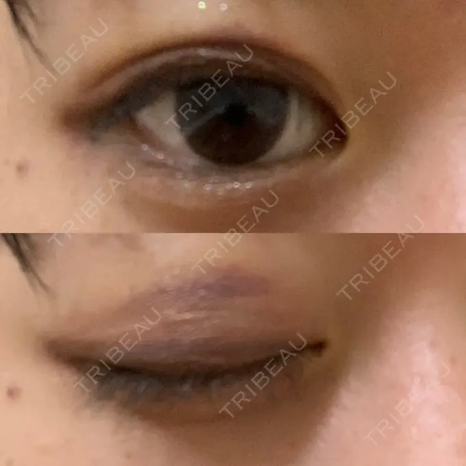 二重埋没 湘南美容クリニック 金沢院 DAY 9 メイン用