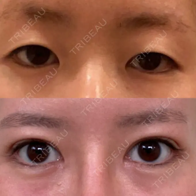 二重切開 / 目頭切開 / 眼瞼下垂（切開） / 目尻切開 RG整形外科（旧リオン整形外科） AFTER メイン用