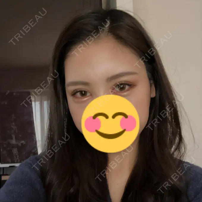 二重切開 / 目頭切開 / クマ治療 / バッカルファット除去 / 脂肪吸引（顔） / 額を丸く / 目尻切開 ヴェリテクリニック 名古屋院 DAY 35 メイン用