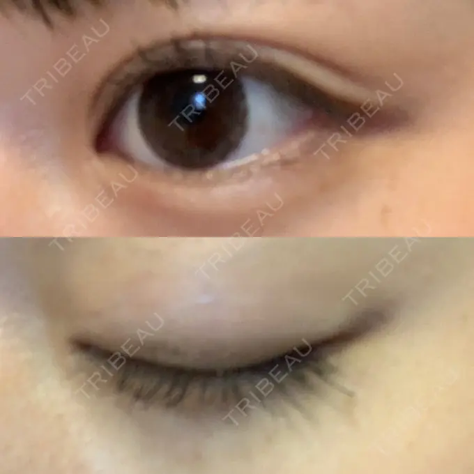 二重埋没 湘南美容クリニック 金沢院 DAY 11 メイン用