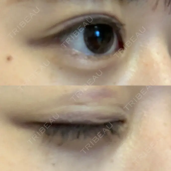 二重埋没 湘南美容クリニック 金沢院 DAY 11 メイン用