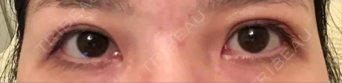 眼瞼下垂（切開） あきこクリニック DAY 43 メイン用