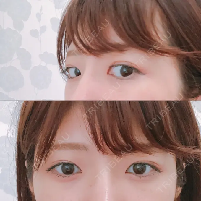 脂肪溶解注射（まぶた） 銀座フェイスクリニック（小顔整形・輪郭整形專門） DAY 14 メイン用