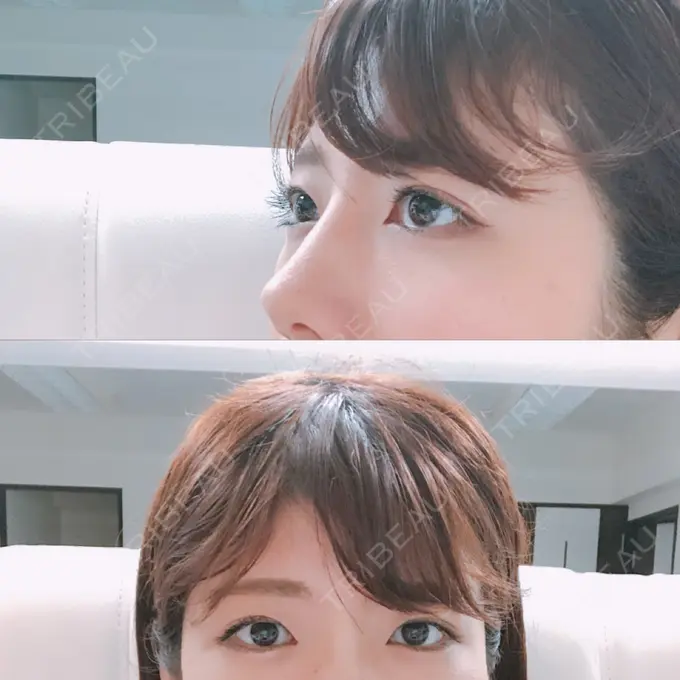 脂肪溶解注射（まぶた） 銀座フェイスクリニック（小顔整形・輪郭整形專門） DAY 25 メイン用