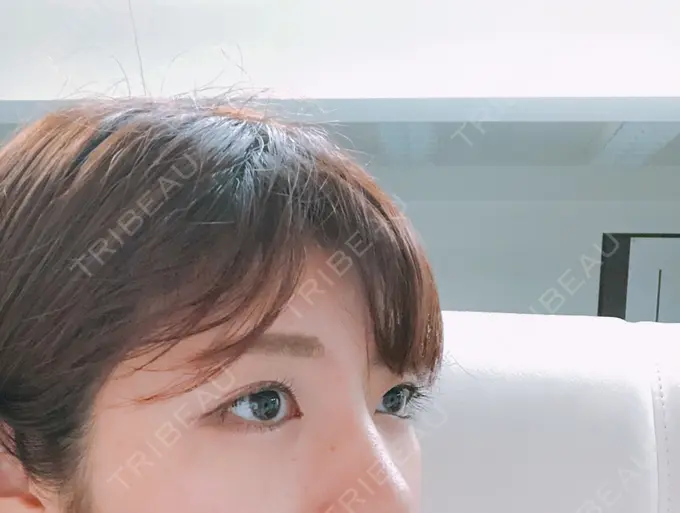 脂肪溶解注射（まぶた） 銀座フェイスクリニック（小顔整形・輪郭整形專門） DAY 25 メイン用