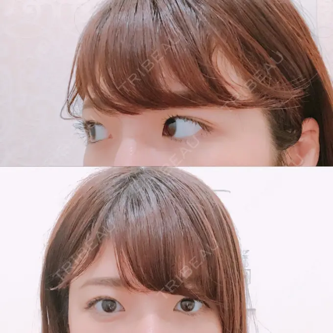 脂肪溶解注射（まぶた） 銀座フェイスクリニック（小顔整形・輪郭整形專門） DAY 26 メイン用