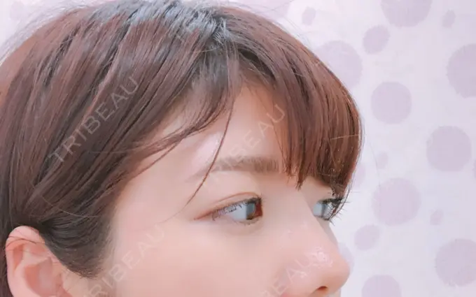 脂肪溶解注射（まぶた） 銀座フェイスクリニック（小顔整形・輪郭整形專門） DAY 26 メイン用