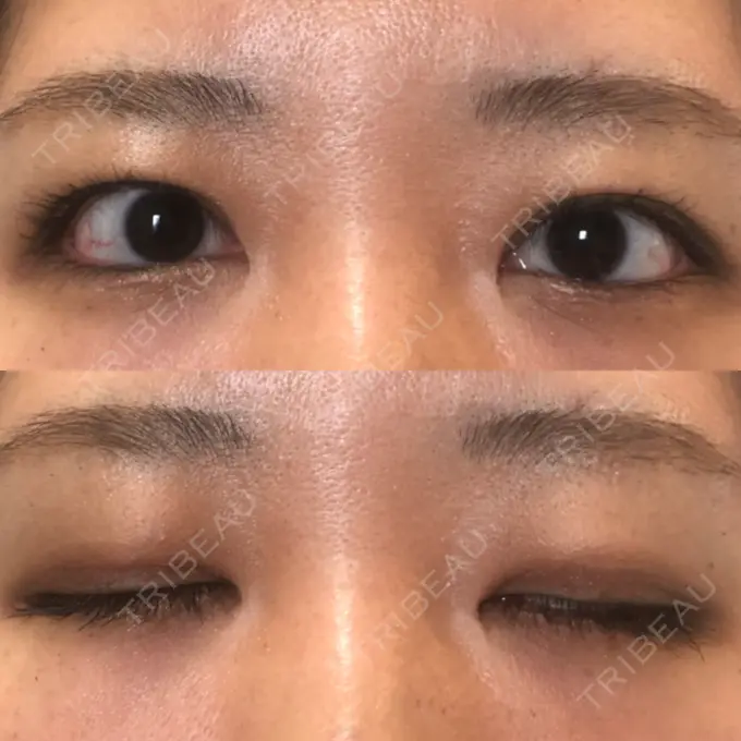 二重切開 / 目頭切開 / その他（目元） 新前橋かしま眼科形成外科クリニック DAY 57 メイン用