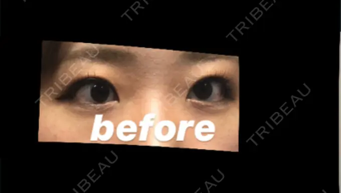 二重切開 / 目頭切開 / その他（目元） 新前橋かしま眼科形成外科クリニック DAY 57 メイン用